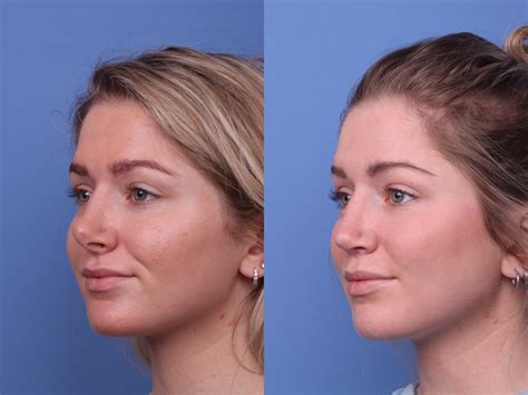 Plastic Surgery Before And After Nose Jobs