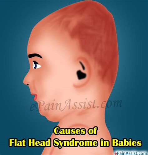 Causes Of Flat Head Syndrome In Babies And Ways To Prevent It