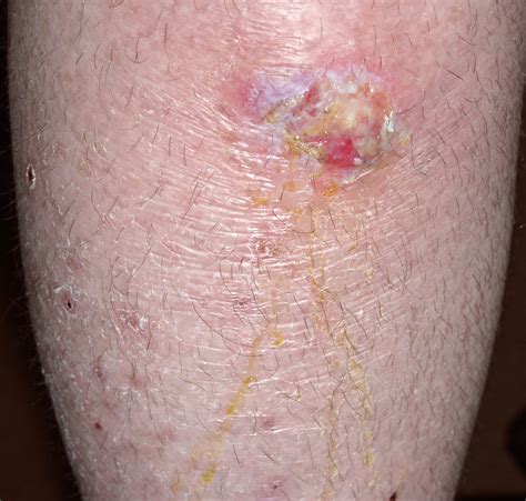 Diabetes Leg Rash Help Health