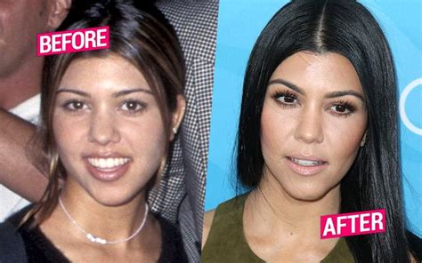 Kourtney Too Kardashian Had Surgery Like Her Sisters Top Docs Claim