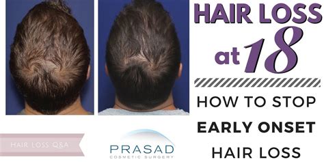 Hair Loss At 18 A Better Treatment For Early Onset Hair Loss Than Prp