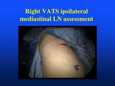 Ppt Vats Mediastinal Lymph Node Dissection Aats Focus On Lung Cancer