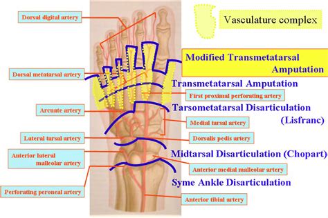 Amputation Causes Types Of Amputation And Amputation Complications