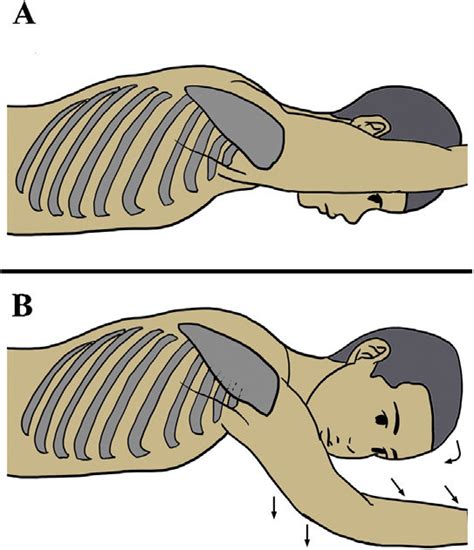 Positions During Surgery A Conventional Arm Position In The Prone
