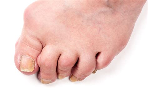 Foot And Ankle Hammer Toe Aoa Orthopedic Specialists