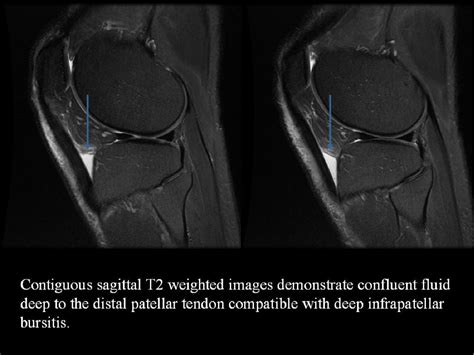 Figure 6 From Bursae Of The Knee A Clinical And Radiological Review