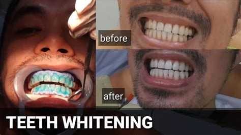 My Professional Teeth Whitening Experience With Before And After Pics