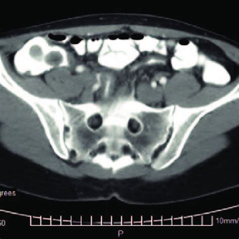 Ct Scan Demonstrating Small Bowel Intussusception Into The Cecum And