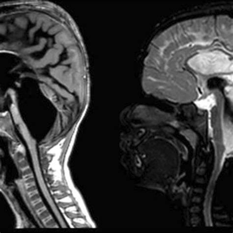 Case 1 Left Previous Ct Showing Slit Ventricle Morphology Right