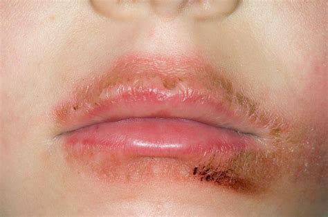 Dermatitis Around The Mouth Photograph By Dr P Marazziscience Photo
