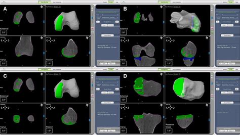 Computed Tomography Based Preoperative Planning For Download