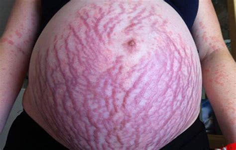 You Wont Believe What Caused This Pregnant Womans Rash New Idea