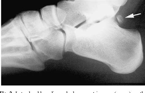 Accessory Navicular Bone Of Foot Disorder Semantic Scholar