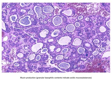 Pathology Outlines Follicular Adenoma