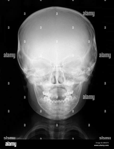 Normal X Ray Of The Head Of A 3 Year Old Boy X Ray Of The Head And