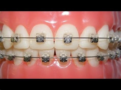 Braces can help straighten your teeth and brighten your smile, but having to keep them on for so long can seem like torture. Getting Braces - Do They Hurt? - YouTube