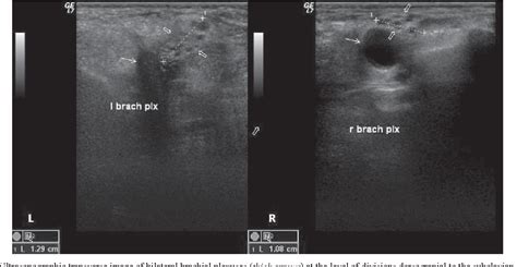 Figure 2 From Neoplastic Brachial Plexopathy Detected By