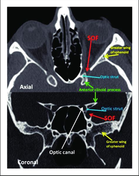 What Is The Orbit In Anatomy Anatomical Charts And Posters