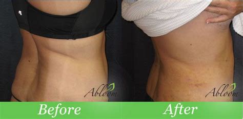 Smartlipo Triplex Love Handles Before And After Photo By Abloom Med Spa