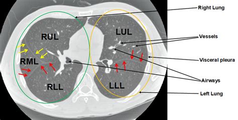 Figure A1 An Axial Lung Ct Slice With Visible Fissures The Left