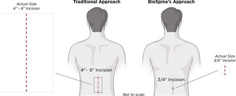 Minimally Invasive Spine Procedures Biospine Institute
