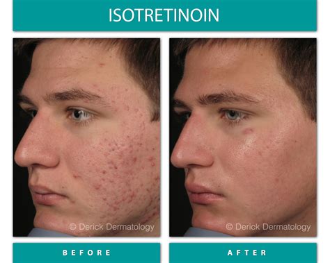 Dermatologist Before And After