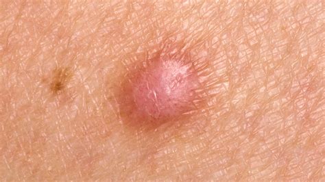 What Is A Skin Lump Symptoms Causes Diagnosis Treatment And Prevention