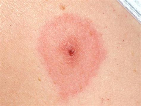 What Does A Tick Bite Rash Look Like Images And Photos Finder
