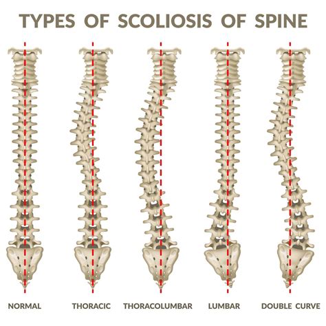 Scoliosis Chiropractor Golden Co Scoliosis Treatment Center Colorado