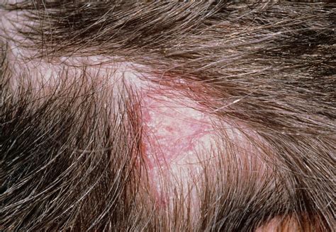 Tinea Capitis Ringworm Of The Scalp Lesion Stock Image M2700155
