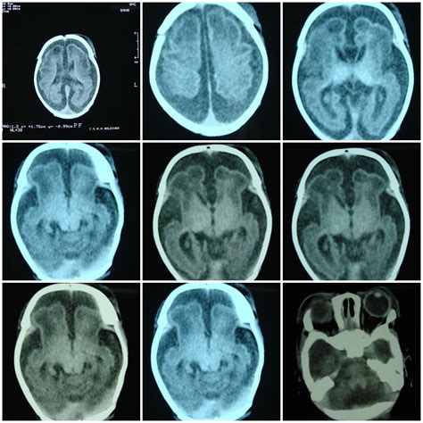 Cerebral Atrophy Ct Scan Images Showing Severe Cerebral At Flickr