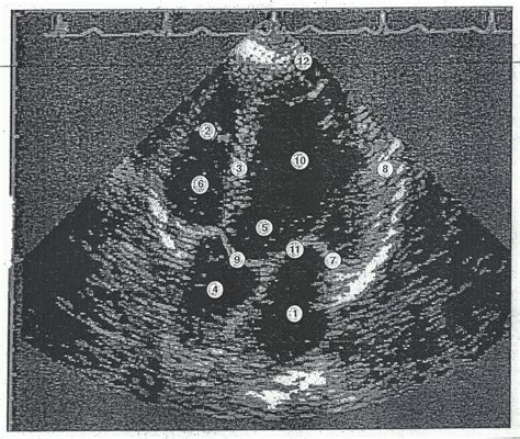 Apical 5 Chamber View Diagram Quizlet