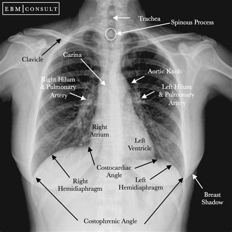 Chest Xray Radiograph Ap View Image Radiology Radiology Student