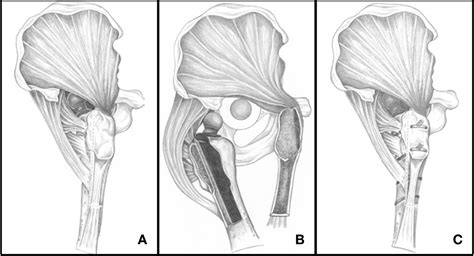 Figure 1 From Modified Extended Trochanteric Osteotomy With