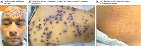 Veterinarians can generally detect liver diseases with a thorough examination. Purple Crusted Nodules in a Patient With End-stage Liver ...