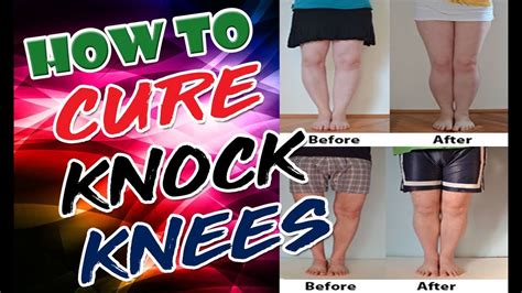 How To Cure Knock Knees Best Result For How To Cure Knock Knees Youtube