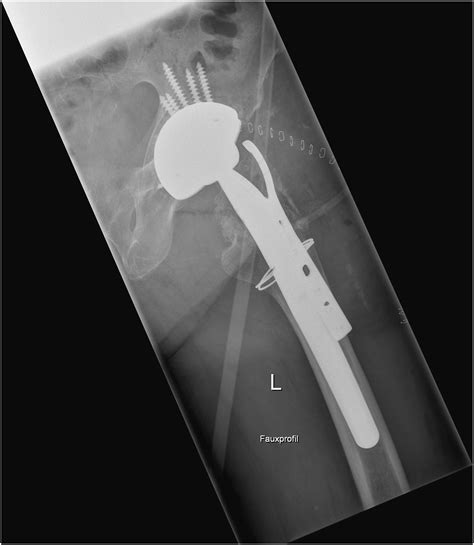 Outcomes Of Osteosynthesis Of Periprosthetic Fractures Of The Greater