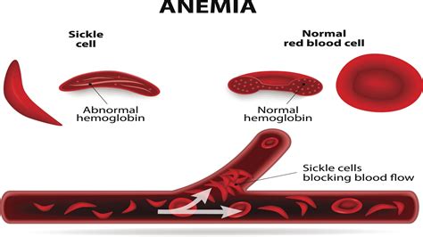 Sickle Cell Anemia Health Hearty