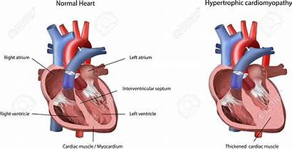 Heart Cardiomyopathy Hypertrophic Ventricle Clipart Problem Myectomy