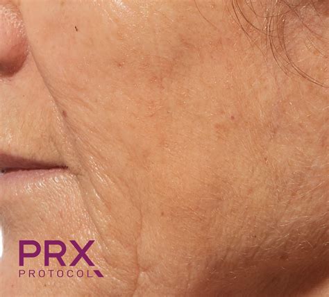 Prx T33 Peel — Ideal Skin Medspa