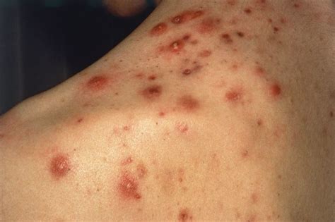 Combo Therapy Appears Safe Effective For Severe Inflammatory Acne Dermatology Advisor