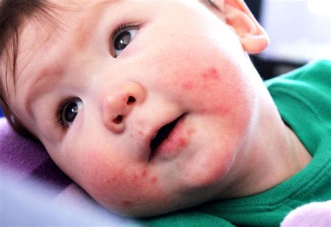 Ask The Doc Im Worried About My Childs Rash What Should I Do