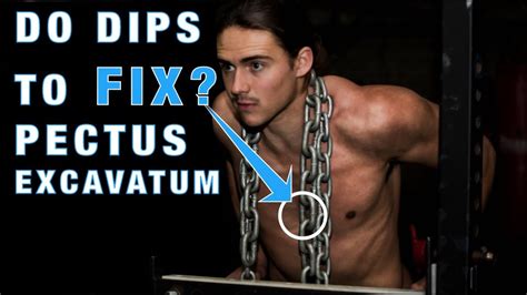 DIPS A Great Exercise To Fix Pectus Excavatum Sunken Chest YouTube