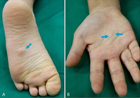 Presence Of Skin Colored Hard Nodules On The Left Sole A And Right