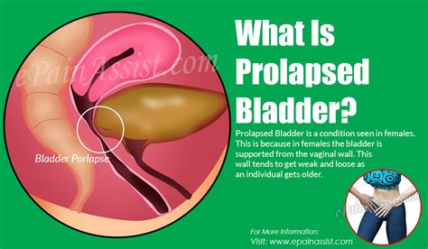 How Long Does Bladder Prolapse Surgery Last Bbznbs