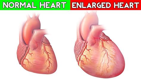 Enlarged Heart Cardiomegaly Causes Symptoms Dangers And Treatment