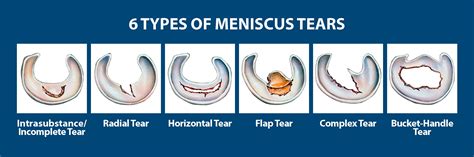 Different Types Of Meniscus Tears