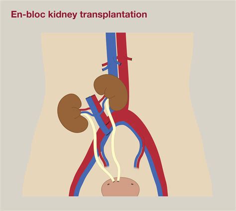 References In Kidney Transplantation Surgery Oxford International