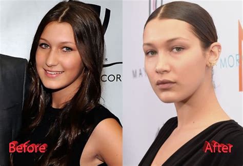 bella hadid before after plastic surgery
