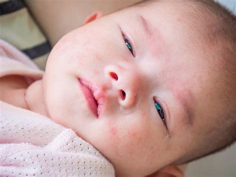 How To Get Rid Of Eczema On Face Baby Baby Eczema Treatment 5 At Home